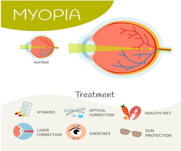 What Is Progressive Myopia and Why Early Detection Matters