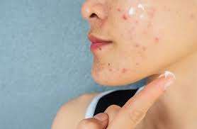 How Acne Treatment Targets Root Causes of Acne